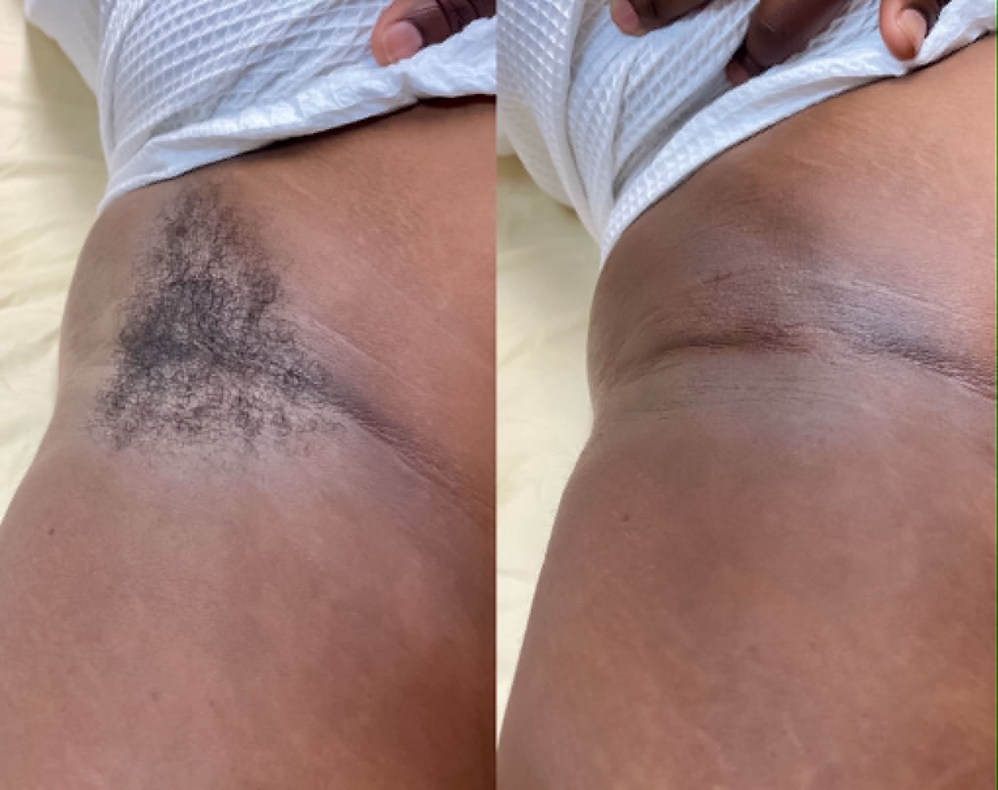Underarm waxing before and after result